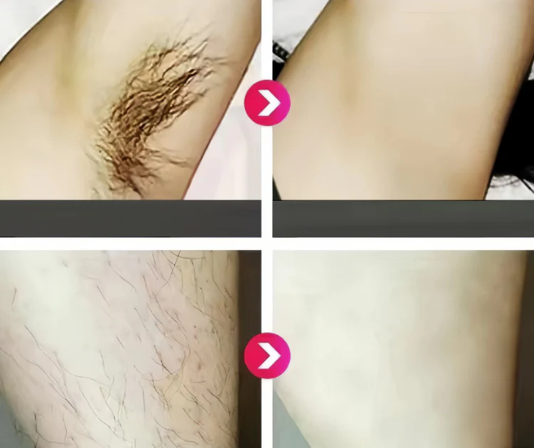 IPL Laser Hair Removal Device جهاز إزالة الشعر بالليزر